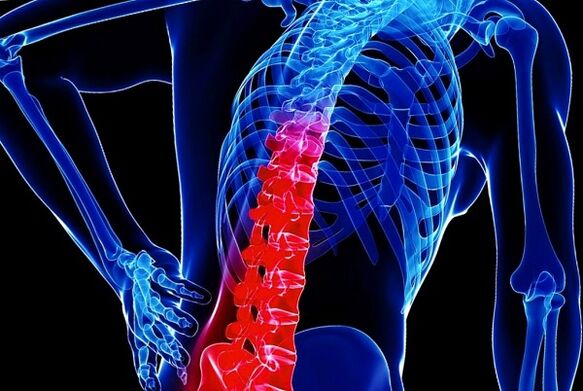 Reasons for the development of thoracic osteochondrosis