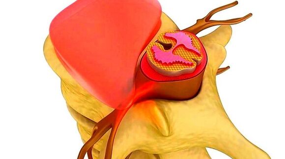 osteochondrosis of the spinal cord of the chest the essence of the disease