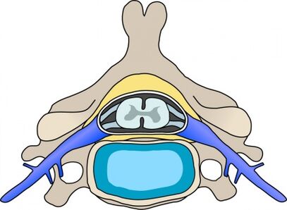 Protabius in the vertebra with osteochondrosis of the cervical