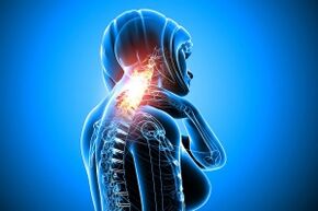 osteochondrosis in the cervical spine