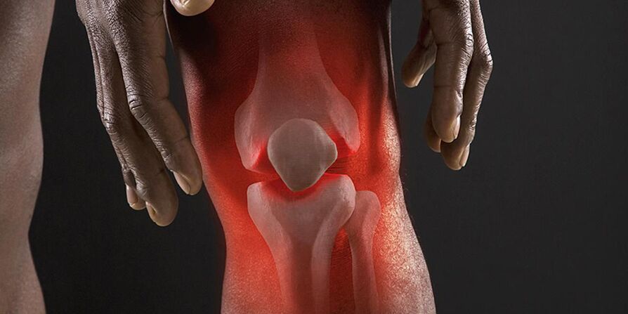 The burning sensation in the knee area is a symptom of gonarthrosis