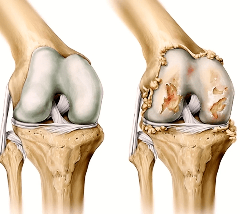 diseased and healthy joint after using Artovitel gel